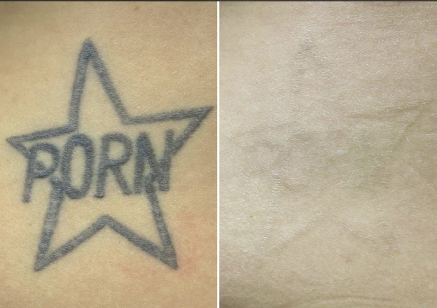 Complete removal on a heavily scarred tattoo
